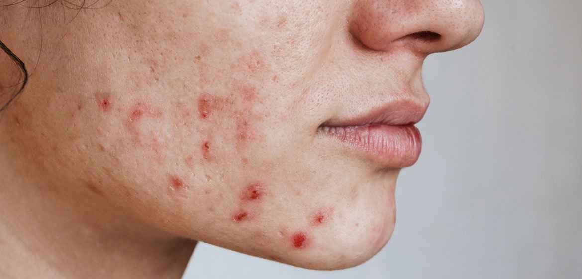 Weibliches Gesicht im Profil von rechts. Auf der Wange sind viele kleine Narbe zu sehen. Im unteren Wangenbereich und am Kinn einige große, rote Pickel.